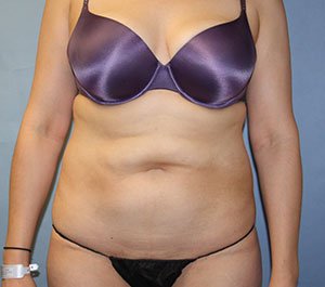 Tummy Tuck before photo - Dr. Cat Beverly Hills