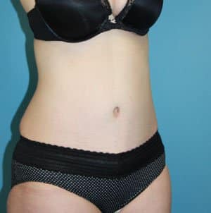 Tummy Tuck after photo - Dr. Cat Beverly Hills