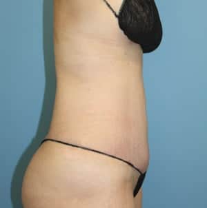 Tummy Tuck after photo - Dr. Cat Beverly Hills