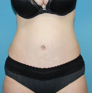 Tummy Tuck after photo - Dr. Cat Beverly Hills