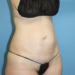 Tummy Tuck before photo - Dr. Cat Beverly Hills
