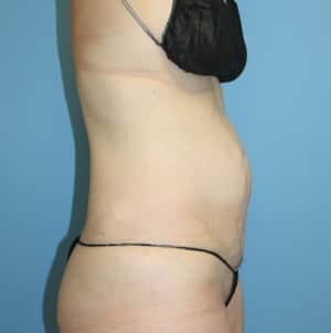 Tummy Tuck before photo - Dr. Cat Beverly Hills