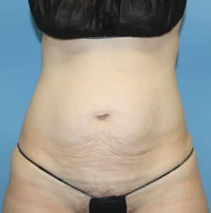 Tummy Tuck before photo - Dr. Cat Beverly Hills