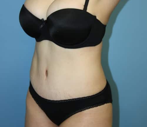 Tummy Tuck after photo - Dr. Cat Beverly Hills