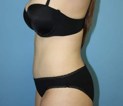 Tummy Tuck after photo - Dr. Cat Beverly Hills