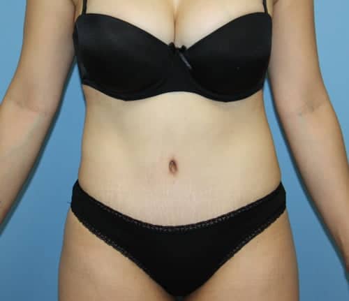 Tummy Tuck after photo - Dr. Cat Beverly Hills