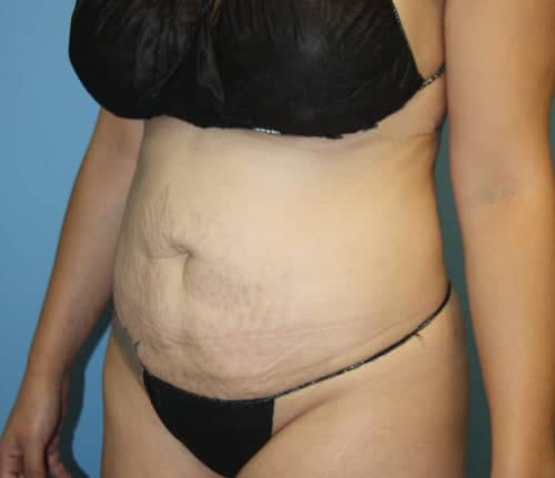 Tummy Tuck before photo - Dr. Cat Beverly Hills