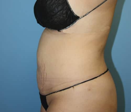 Tummy Tuck before photo - Dr. Cat Beverly Hills