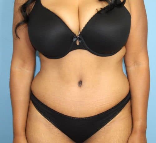 Tummy Tuck after photo - Dr. Cat Beverly Hills