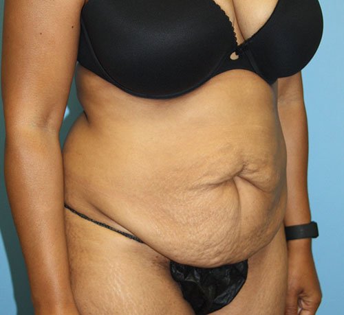 Tummy Tuck before photo - Dr. Cat Beverly Hills