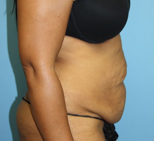 Tummy Tuck before photo - Dr. Cat Beverly Hills