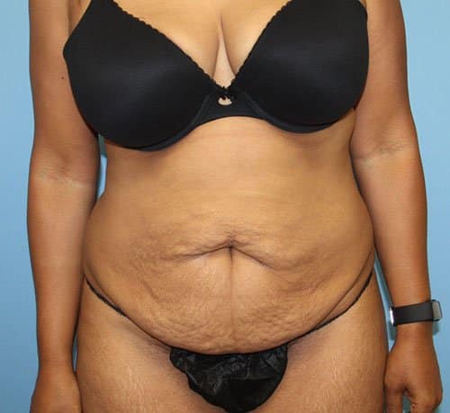Tummy Tuck before photo - Dr. Cat Beverly Hills