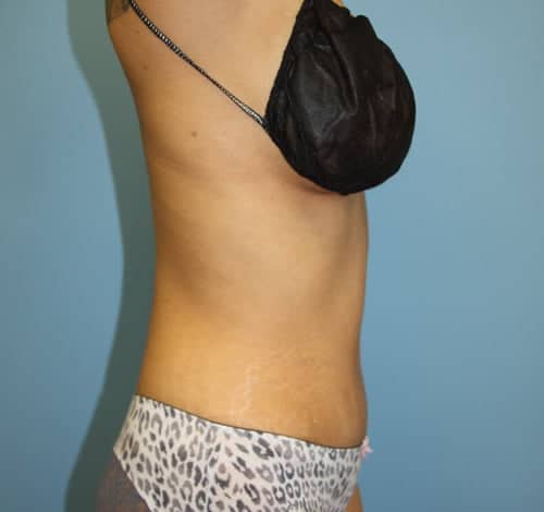 Tummy Tuck after photo - Dr. Cat Beverly Hills