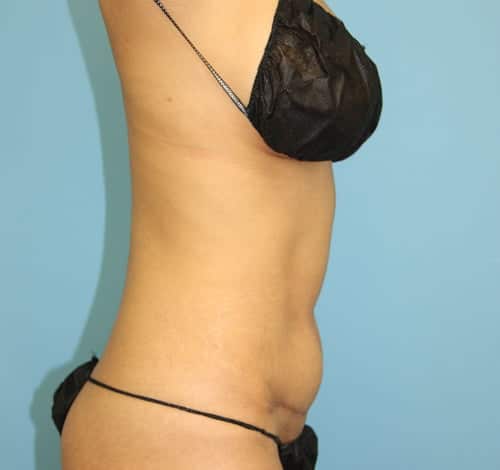 Tummy Tuck before photo - Dr. Cat Beverly Hills