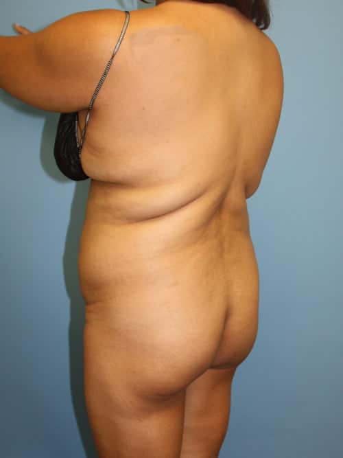 Brazilian Butt Lift before photo - Dr. Cat Beverly Hills