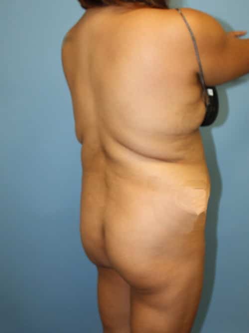 Brazilian Butt Lift before photo - Dr. Cat Beverly Hills