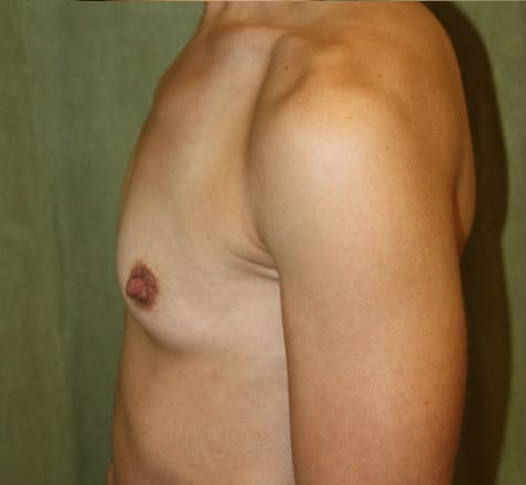 Breast Augmentation before photo - Dr. Cat Beverly Hills