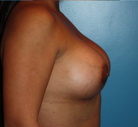 Breast Augmentation after photo - Dr. Cat Beverly Hills