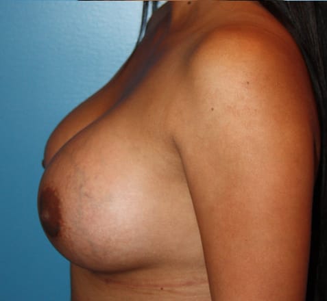 Breast Augmentation after photo - Dr. Cat Beverly Hills
