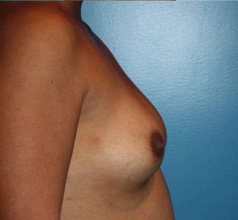 Breast Augmentation before photo - Dr. Cat Beverly Hills