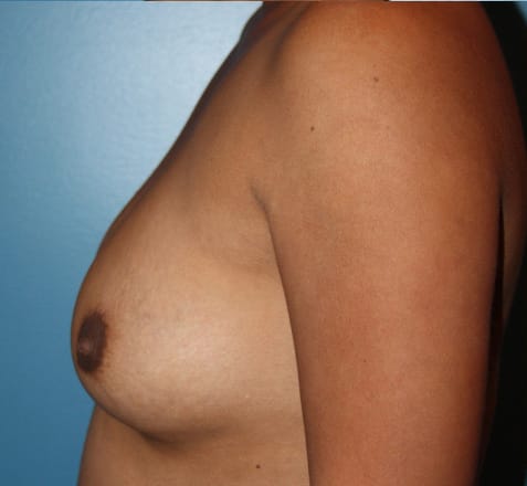Breast Augmentation before photo - Dr. Cat Beverly Hills