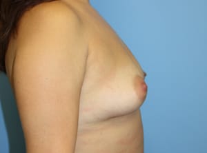 Breast Augmentation before photo - Dr. Cat Beverly Hills