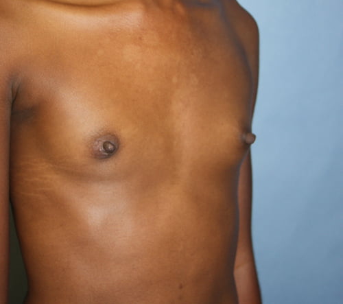 Breast Augmentation before photo - Dr. Cat Beverly Hills