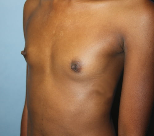 Breast Augmentation before photo - Dr. Cat Beverly Hills