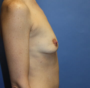 Breast Augmentation before photo - Dr. Cat Beverly Hills