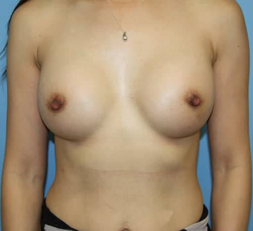 Breast Augmentation after photo - Dr. Cat Beverly Hills