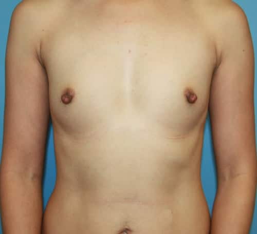 Breast Augmentation before photo - Dr. Cat Beverly Hills