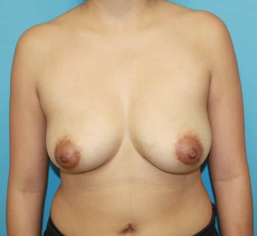 Breast Augmentation before photo - Dr. Cat Beverly Hills