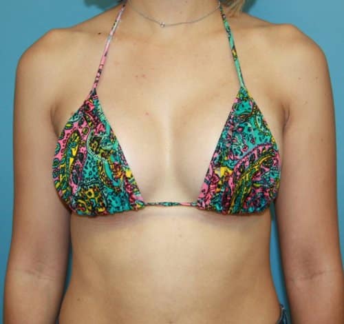Breast Augmentation after photo - Dr. Cat Beverly Hills