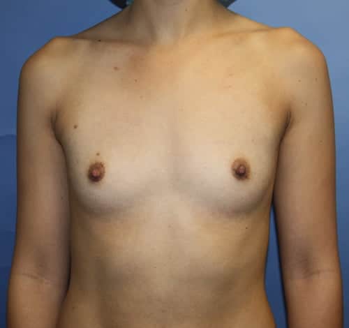 Breast Augmentation before photo - Dr. Cat Beverly Hills