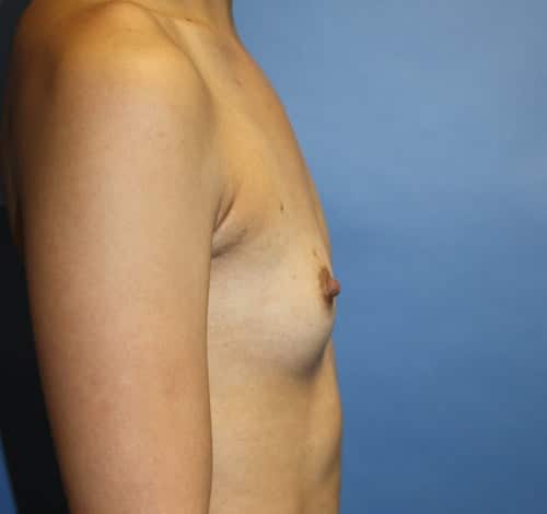 Breast Augmentation before photo - Dr. Cat Beverly Hills