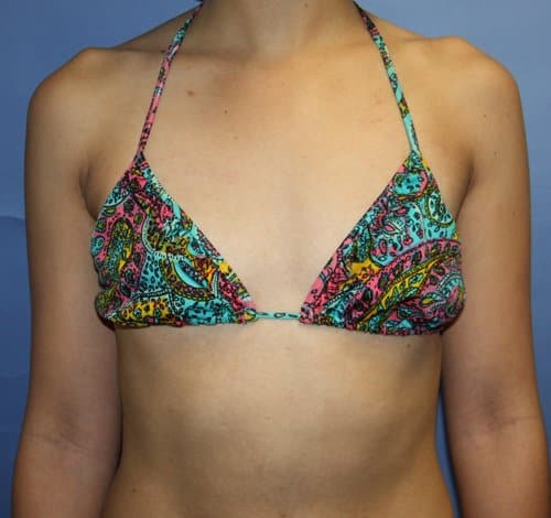 Breast Augmentation before photo - Dr. Cat Beverly Hills
