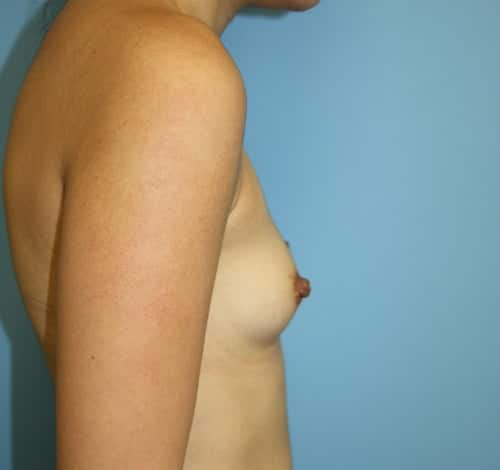 Breast Augmentation before photo - Dr. Cat Beverly Hills