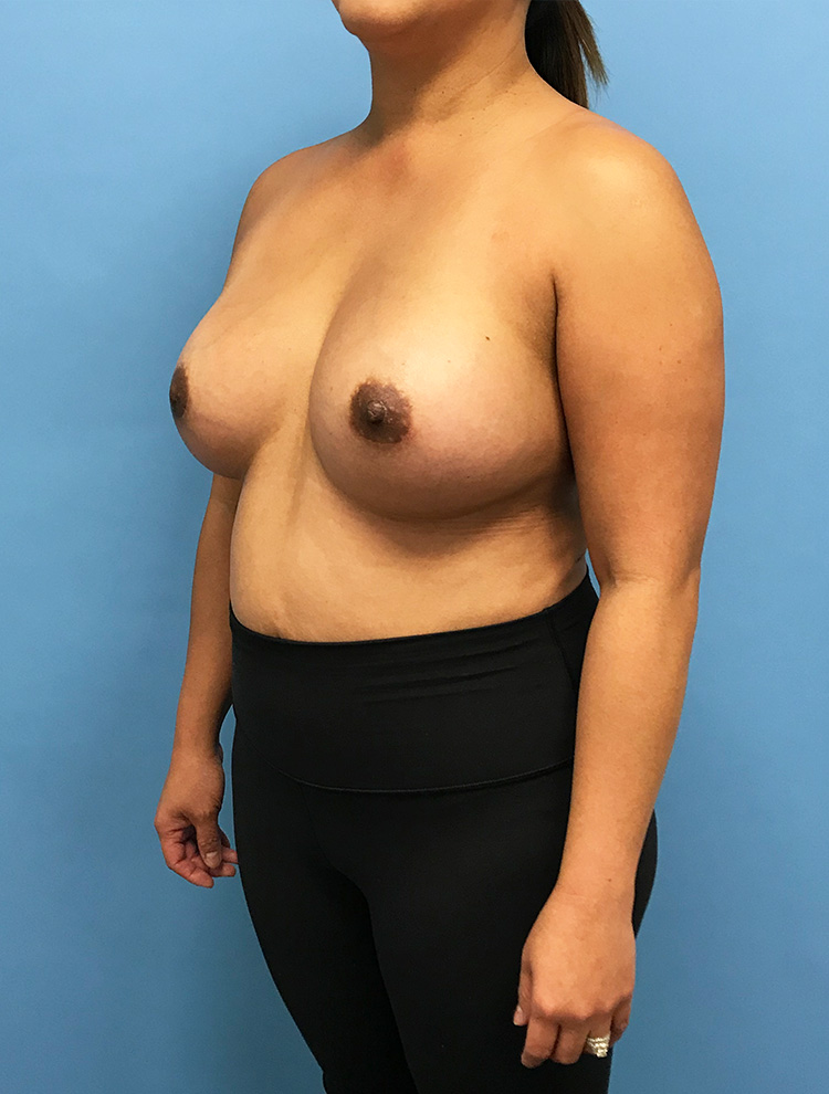 Angled view of a woman after tuberous breast correction surgery