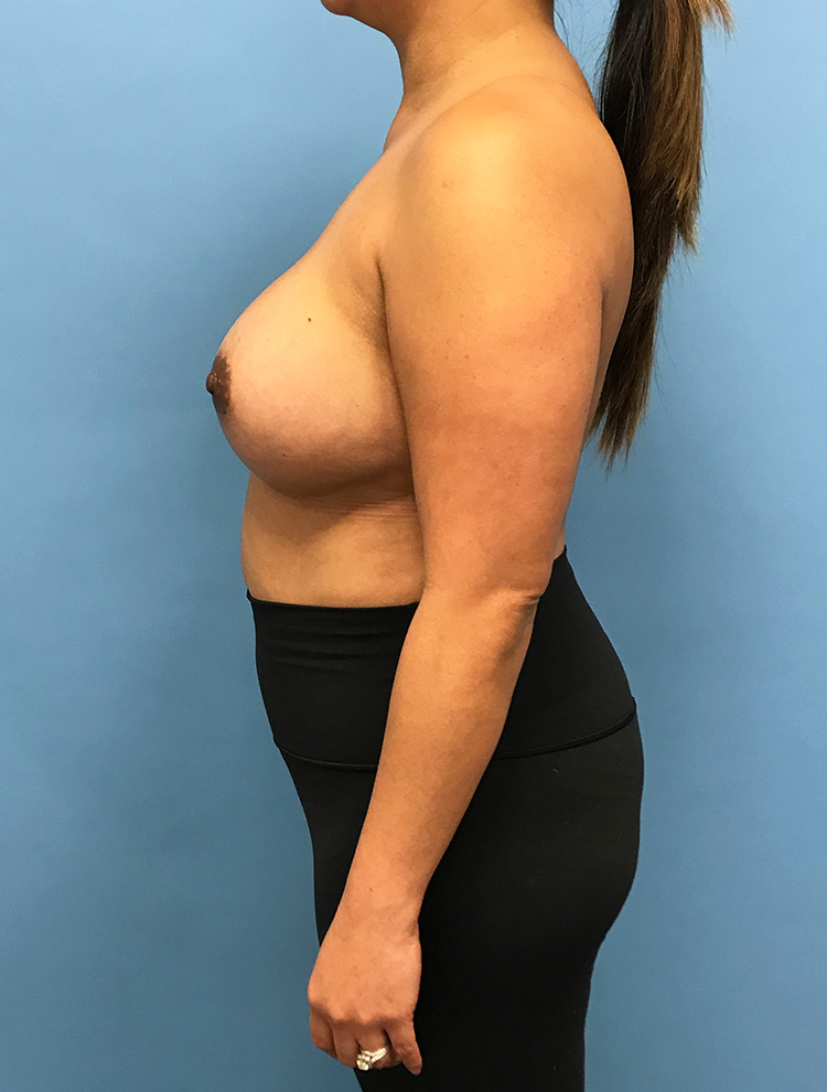 Side view of a woman after tuberous breast correction surgery