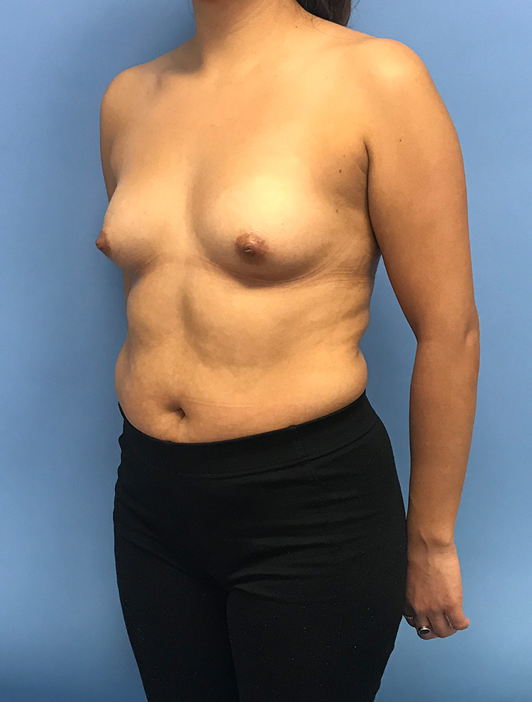 Side profile before breast augmentation surgery.
