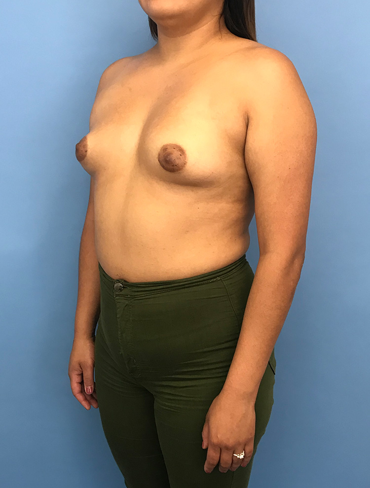 Angled view of a woman before tuberous breast correction surgery