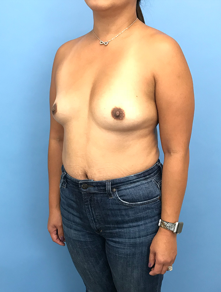 Angled view of a woman before tuberous breast correction surgery