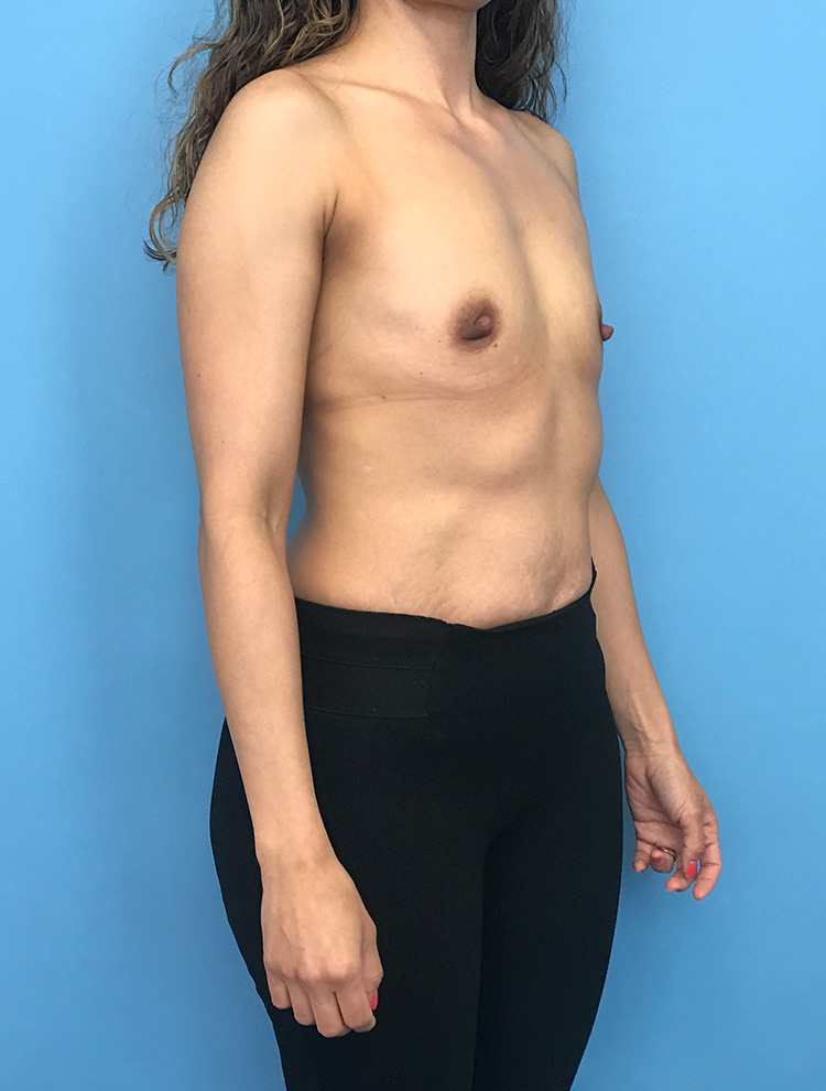 Breast Augmentation before photo angled view - Dr. Cat Beverly Hills