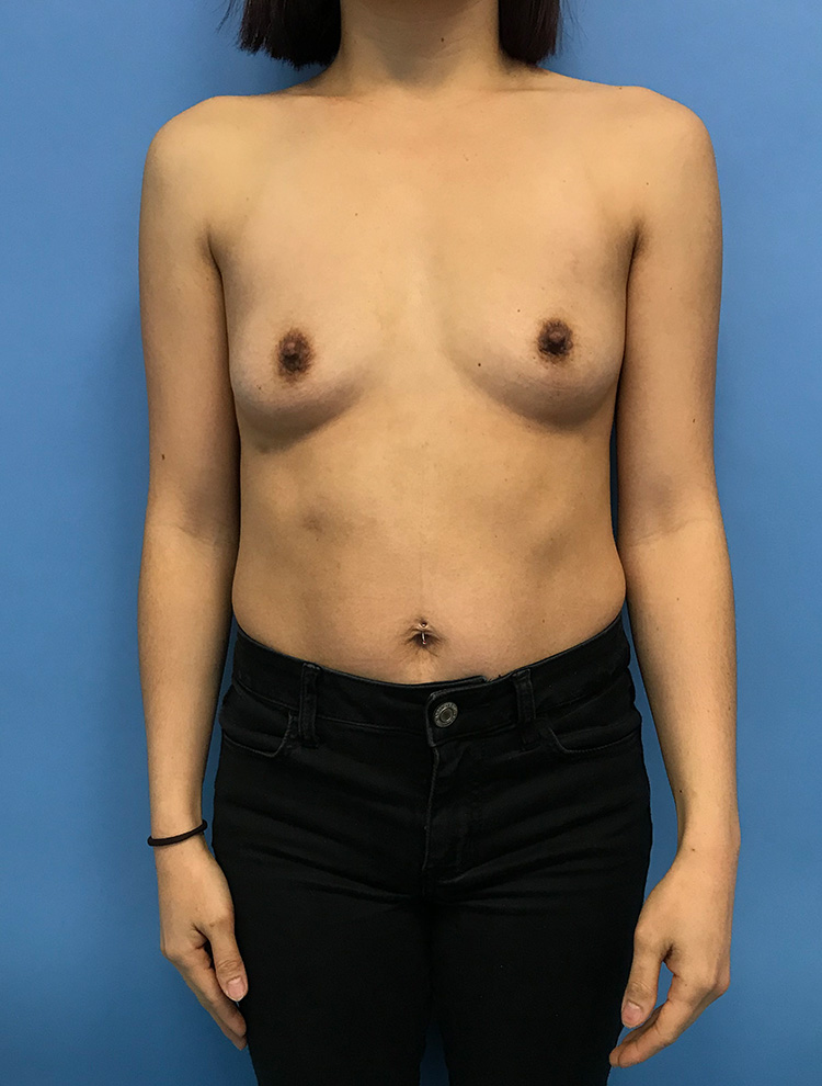 Front view of a woman before breast augmentation surgery with implants