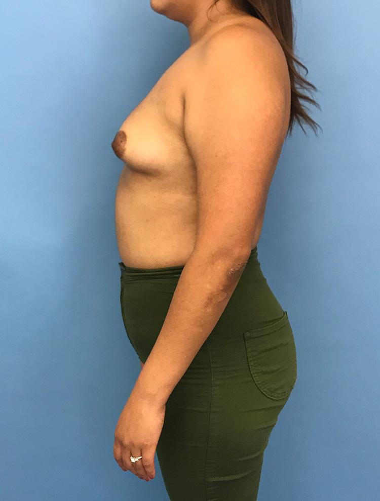 Side view of a woman before tuberous breast correction surgery