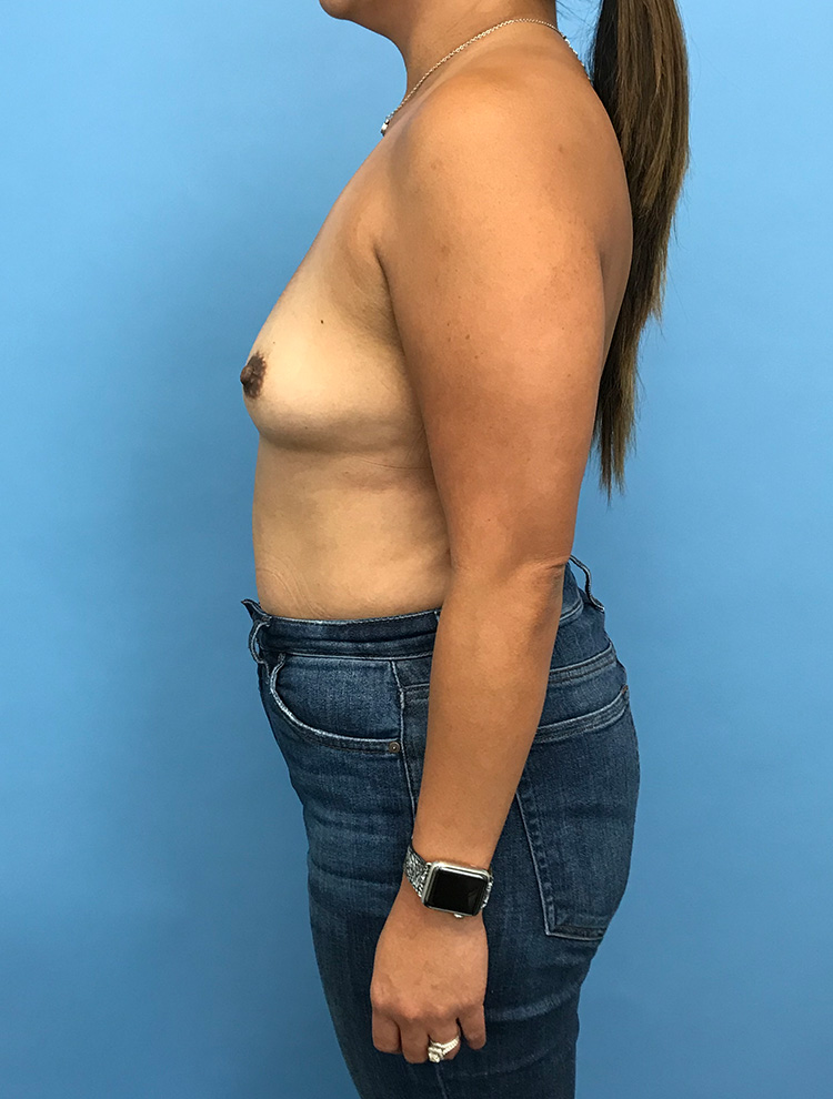 Side view of a woman before tuberous breast correction surgery