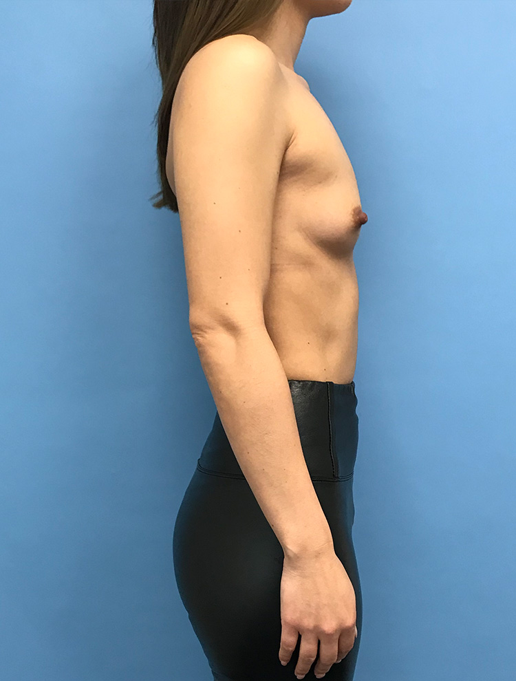 Breast Augmentation before photo side view - Dr. Cat Beverly Hills