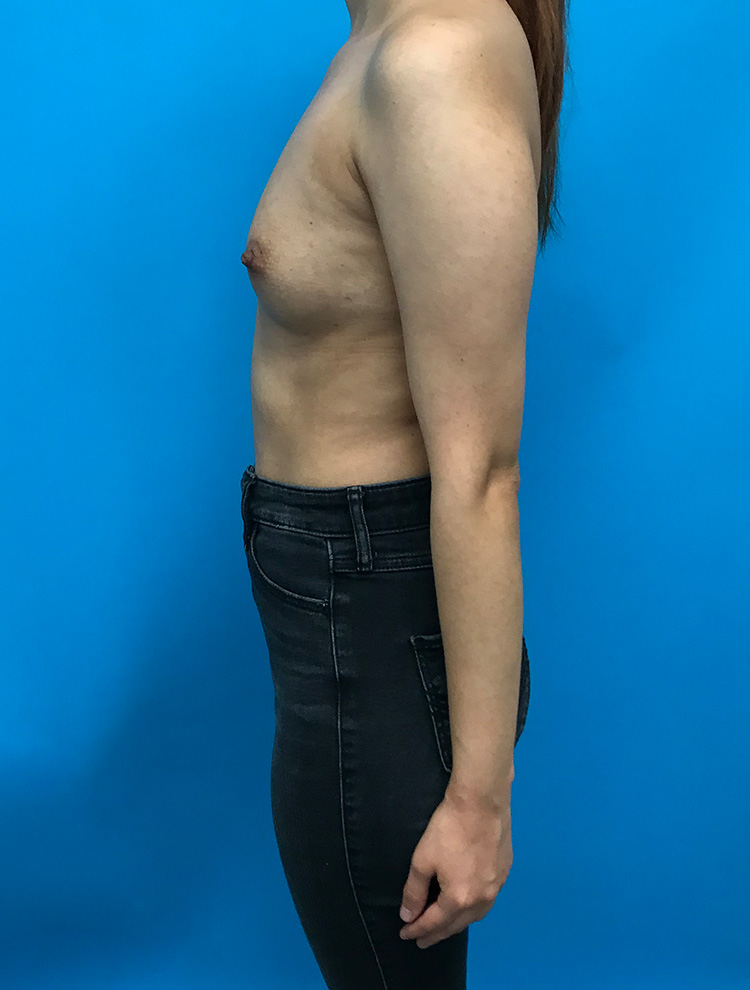 Breast Augmentation before photo side view - Dr. Cat Beverly Hills