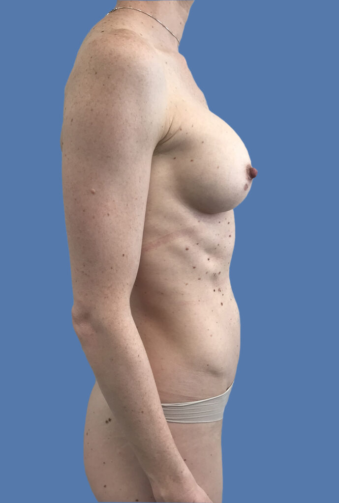 Case BAI-0662 after photo — Dr. Cat, Beverly Hills