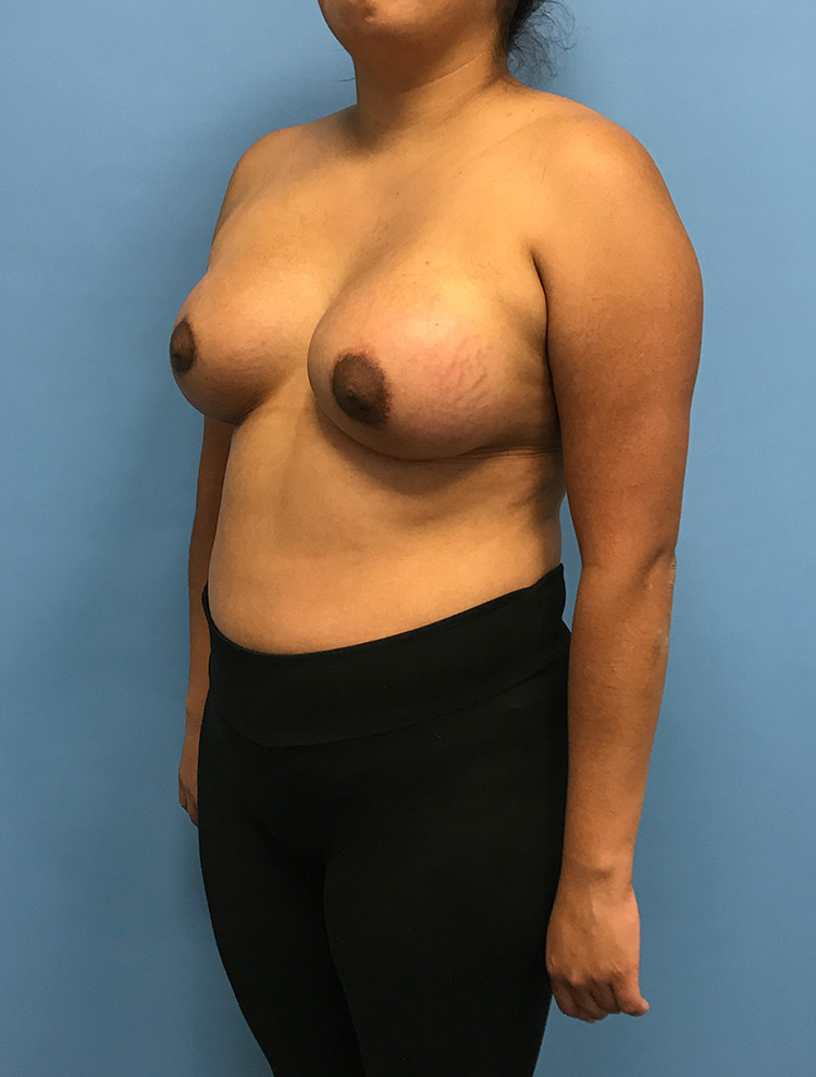 Angled view of a woman after tuberous breast correction surgery